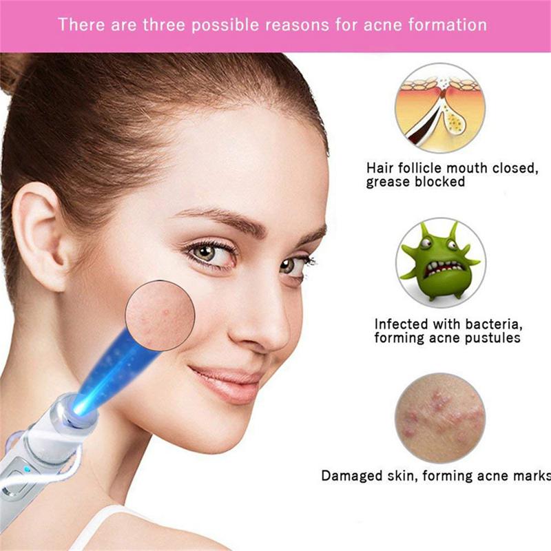 Heath Blue Light Therapy Varicose Veins Treatment Laser Pen Soft Scar Wrinkle Removal Treatment Acne Laser Pen Massage Relax